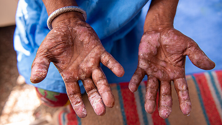 Man with leprosy 