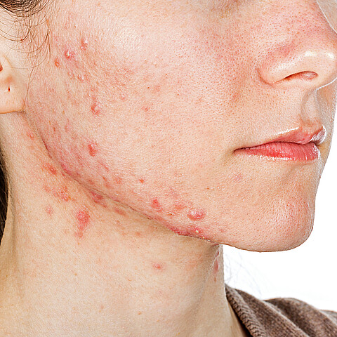 Mujer con rara enfermedad de la piel denuncia que la llaman Freddy Krueger