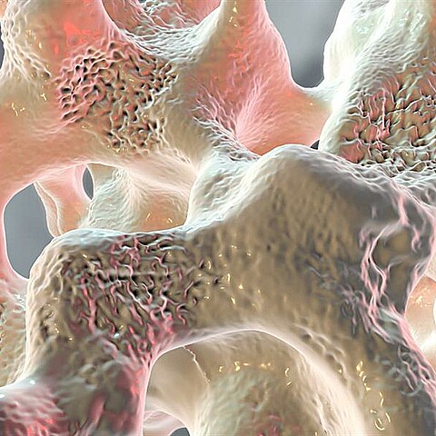 Nuevo medicamento contra la osteoporosis
