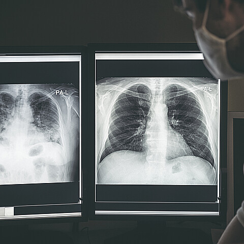 A un hombre se le trabó la dentadura postiza en un pulmón luego de tragársela por accidente