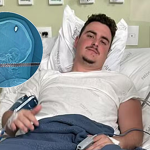 El joven de 21 años estuvo 4 días con una bala en la cabeza sin saberlo 