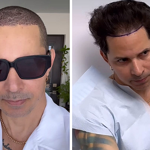 El cantante cubano Leoni Torres se sometió a un trasplante capilar 