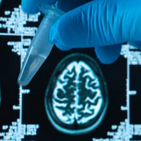 IA detecta Alzheimer