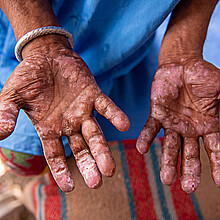 Man with leprosy 