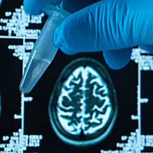 IA detecta Alzheimer